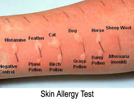 allergy_test.jpg