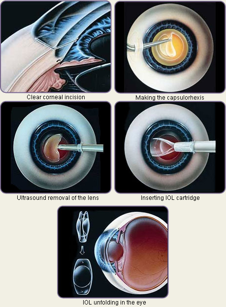 cataract_procedure.jpg