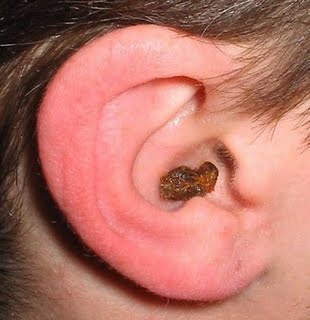 ear_wax2.jpg