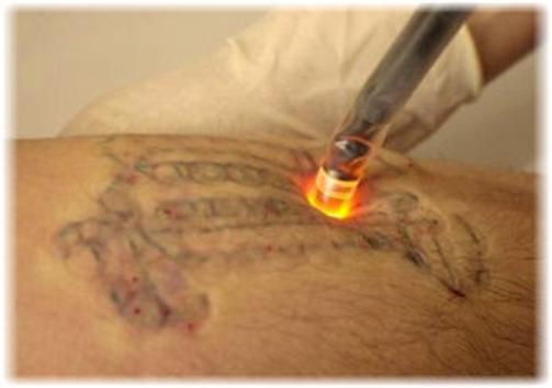 tattoo_removal.jpg