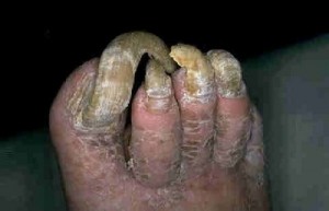 ugly_feet_300x193.jpg